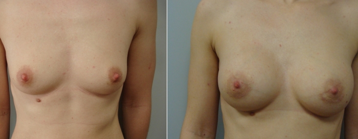Okrugli implantati  - 225mL
